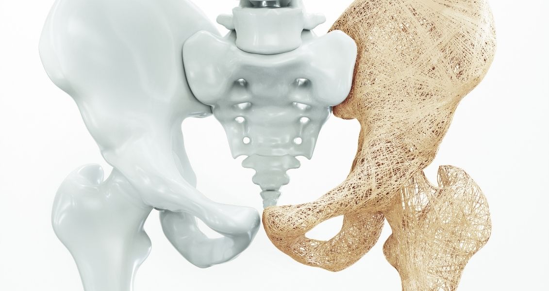 World Osteoporosis Prevention Day